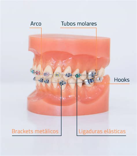 tipos de brackets metalicos|partes de un bracket.